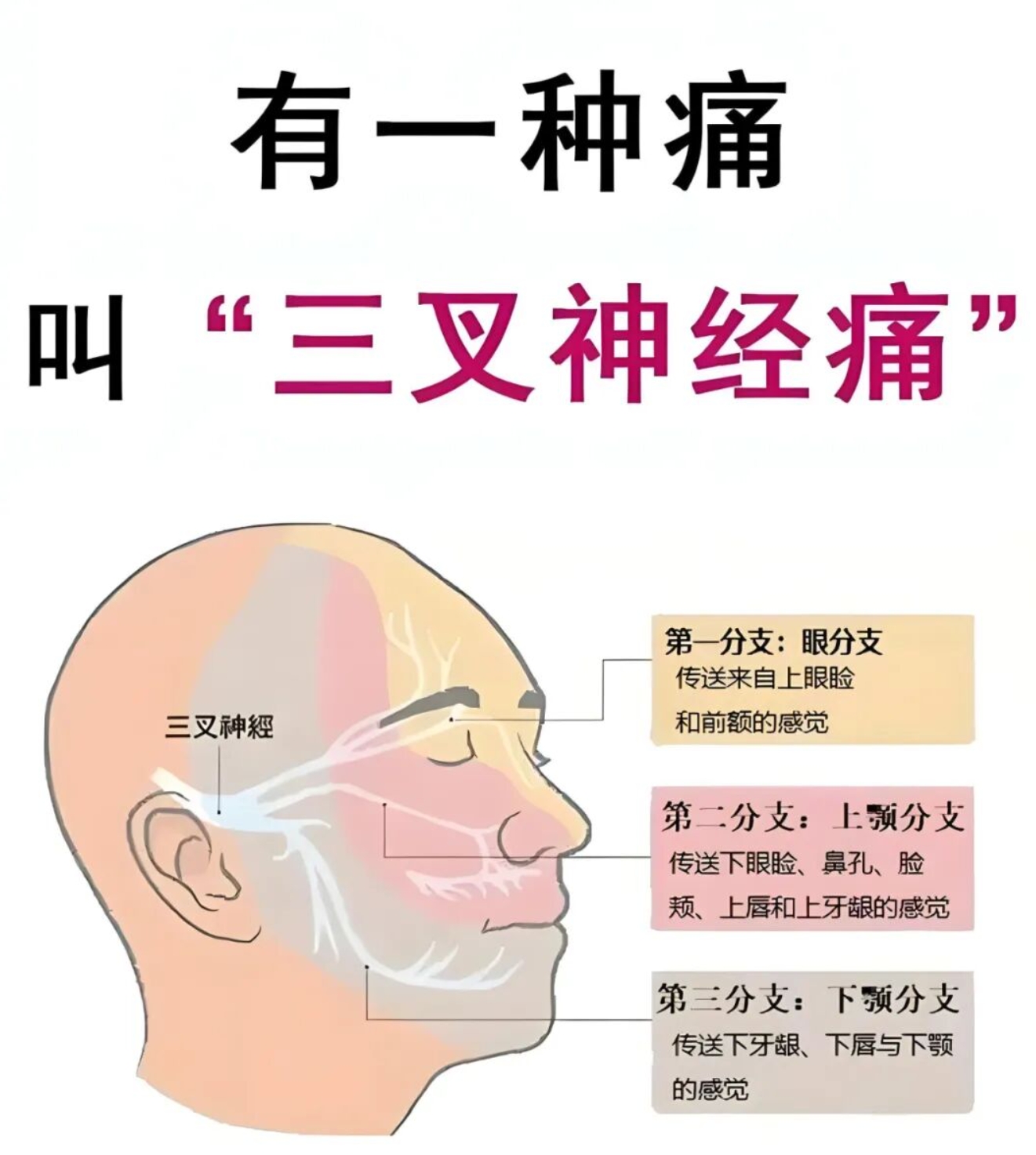 三叉神经痛.jpg 三叉神经痛.jpg